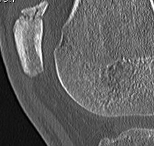 Patella Fracture Nonunion CT